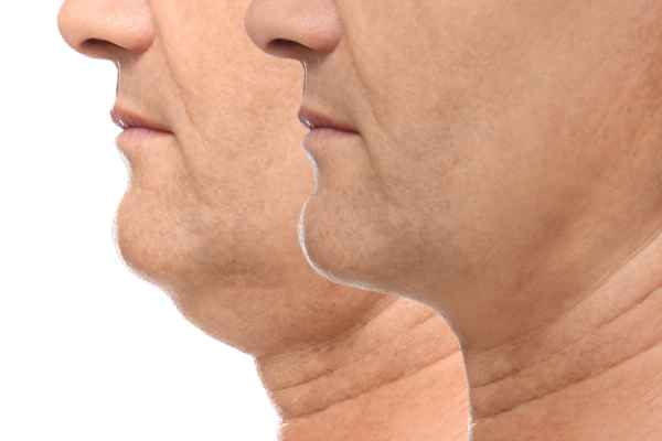 HIFU - Breakthrough in Anti - ageing 2 hifu results Amersham