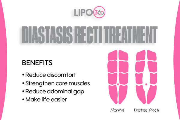 Revolutionising Muscle Repair: The Power of LIPO360 Body Sculpt Post-Injury 5 diastasis recti treatment Amersham