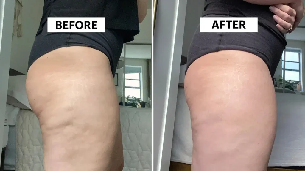 Sculpting Your Bum: Can Toning Exercises Really Reduce Cellulite? 1 Do Toning Exercise Amersham Really Tackle Cellulite?