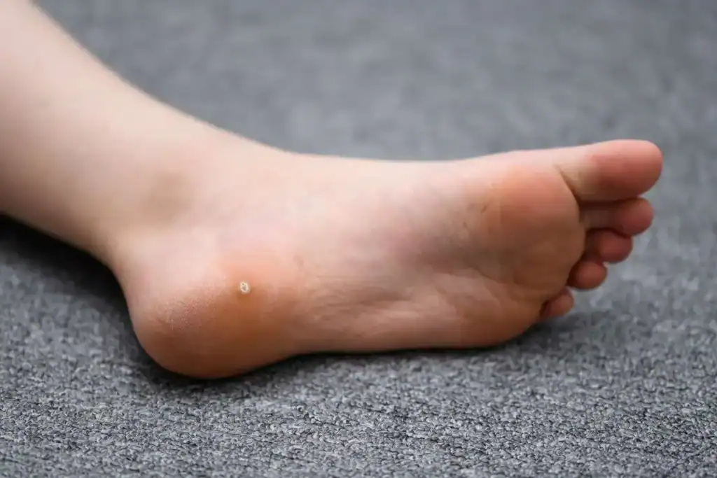 Cryotherapy For Warts And Also Verrucas 2 Image of verruca on the bottom of the foot that able to be treated with Cryotherapy Amersham