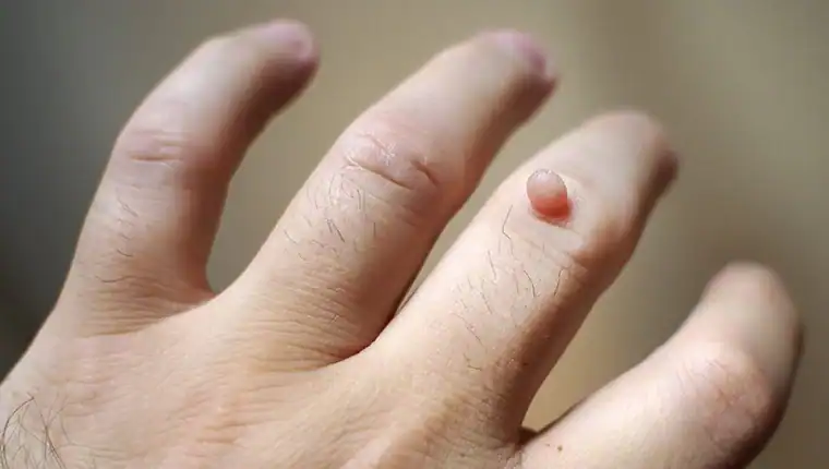 Cryotherapy For Warts And Also Verrucas 1 Image of blemish that Cryotherapy Amersham can remove with Lipo 360.