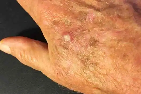 Cryopen For Actinic Keratoses 1 Image of Actinic keratoses Amersham on a person hand