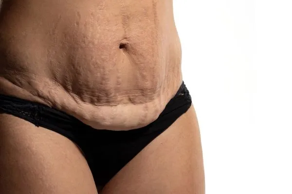 The Science of Skin Tightening 1 The science behind skin tightening Amersham picture of a woman's sagging skin on the stomach